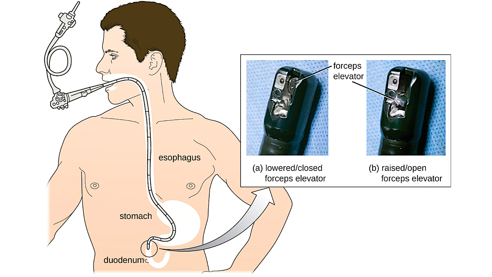 Upper GI Endoscopy Why Is It Done and What the Numbers Mean StoryMD