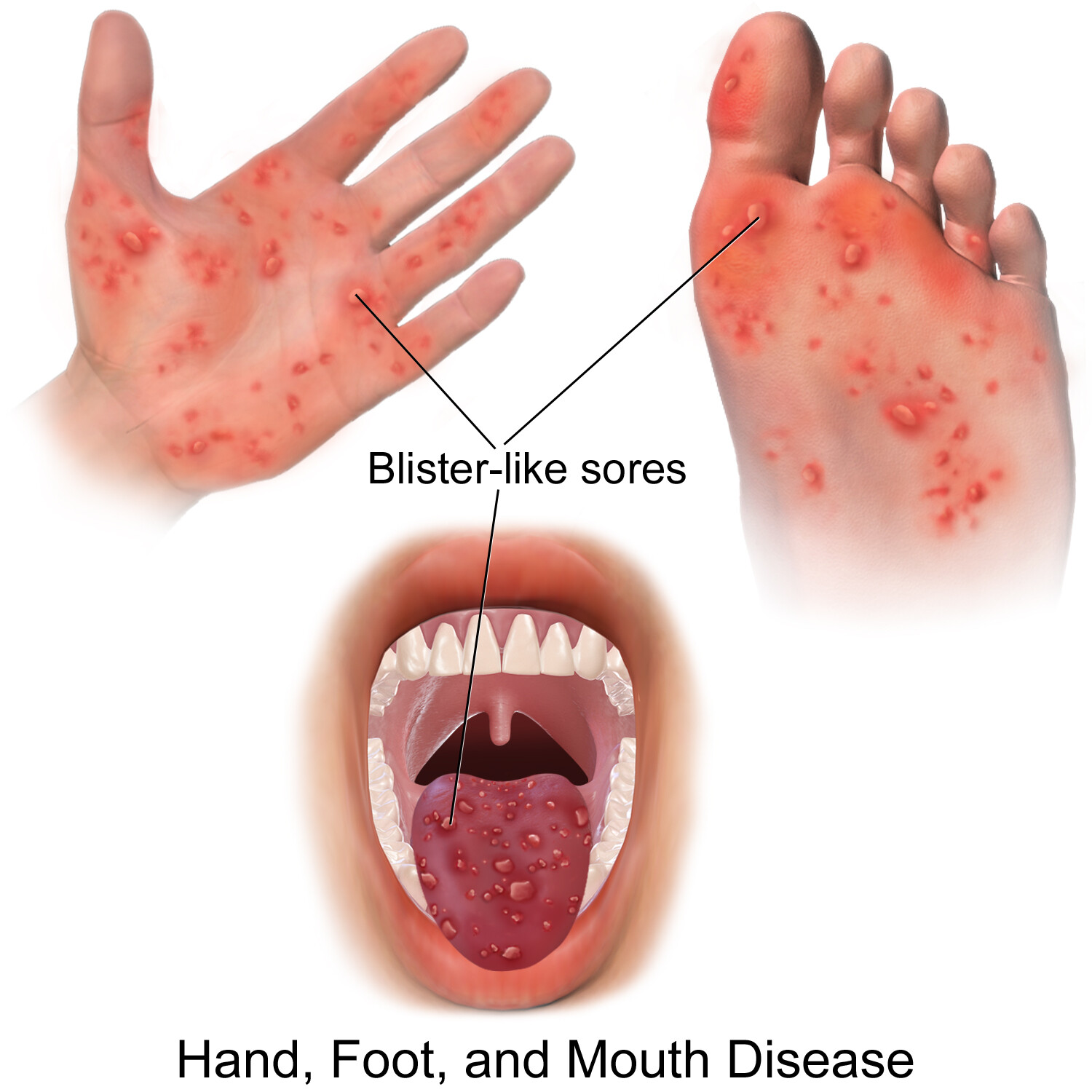 hand foot and mouth disease in mouth