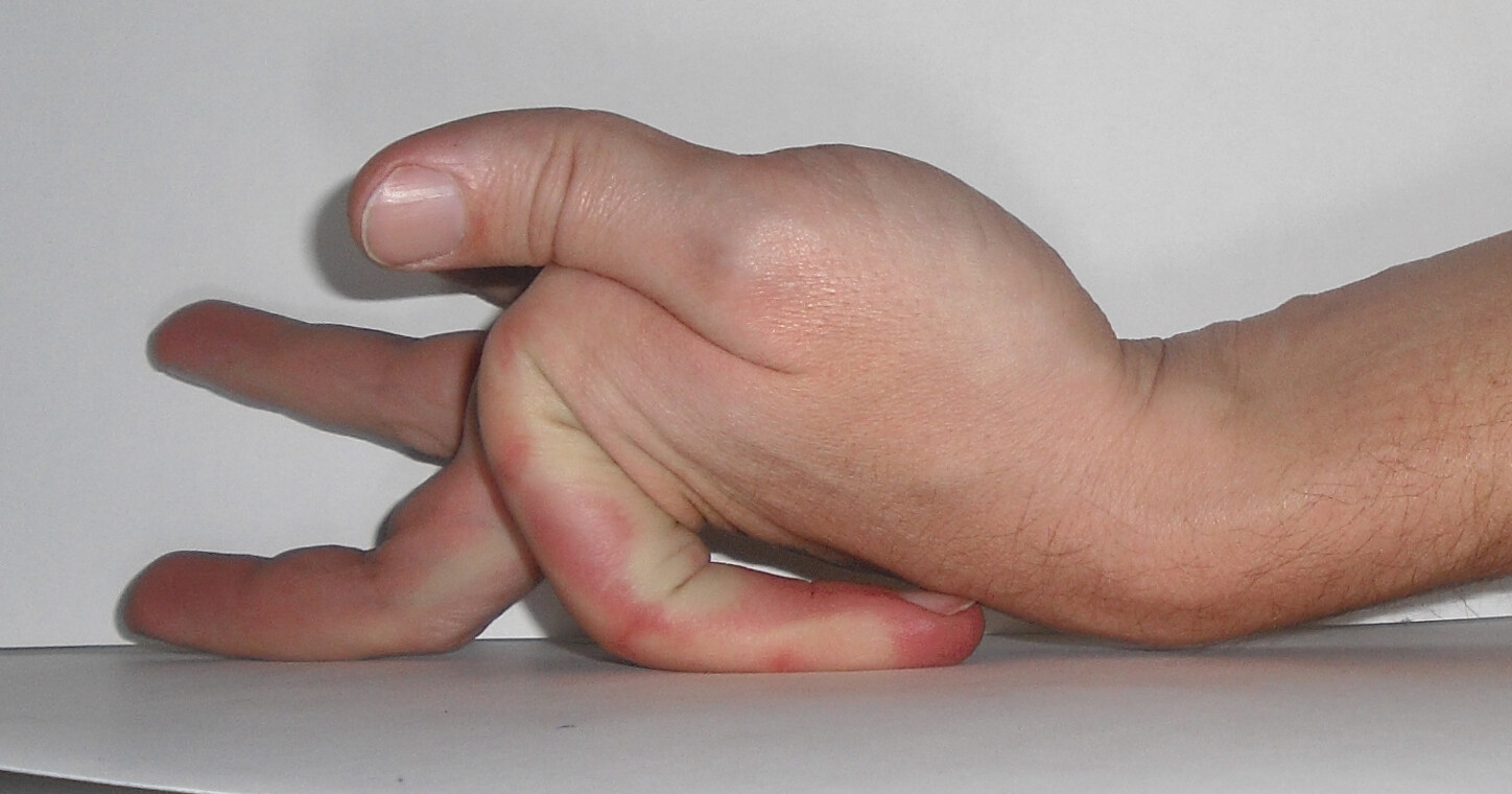 Dupuytren's contracture - Wikipedia