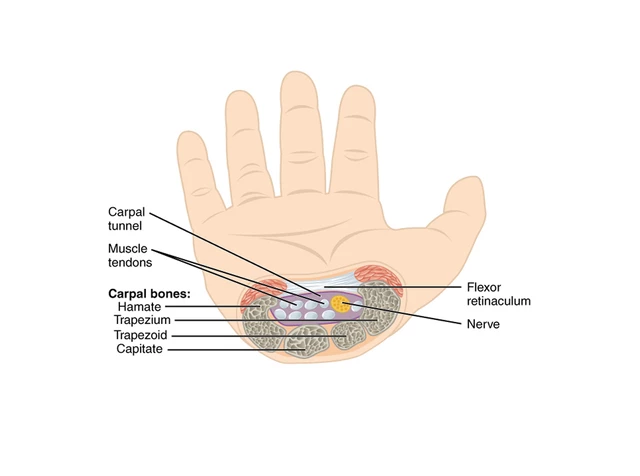 What is Carpal Tunnel Syndrome?
