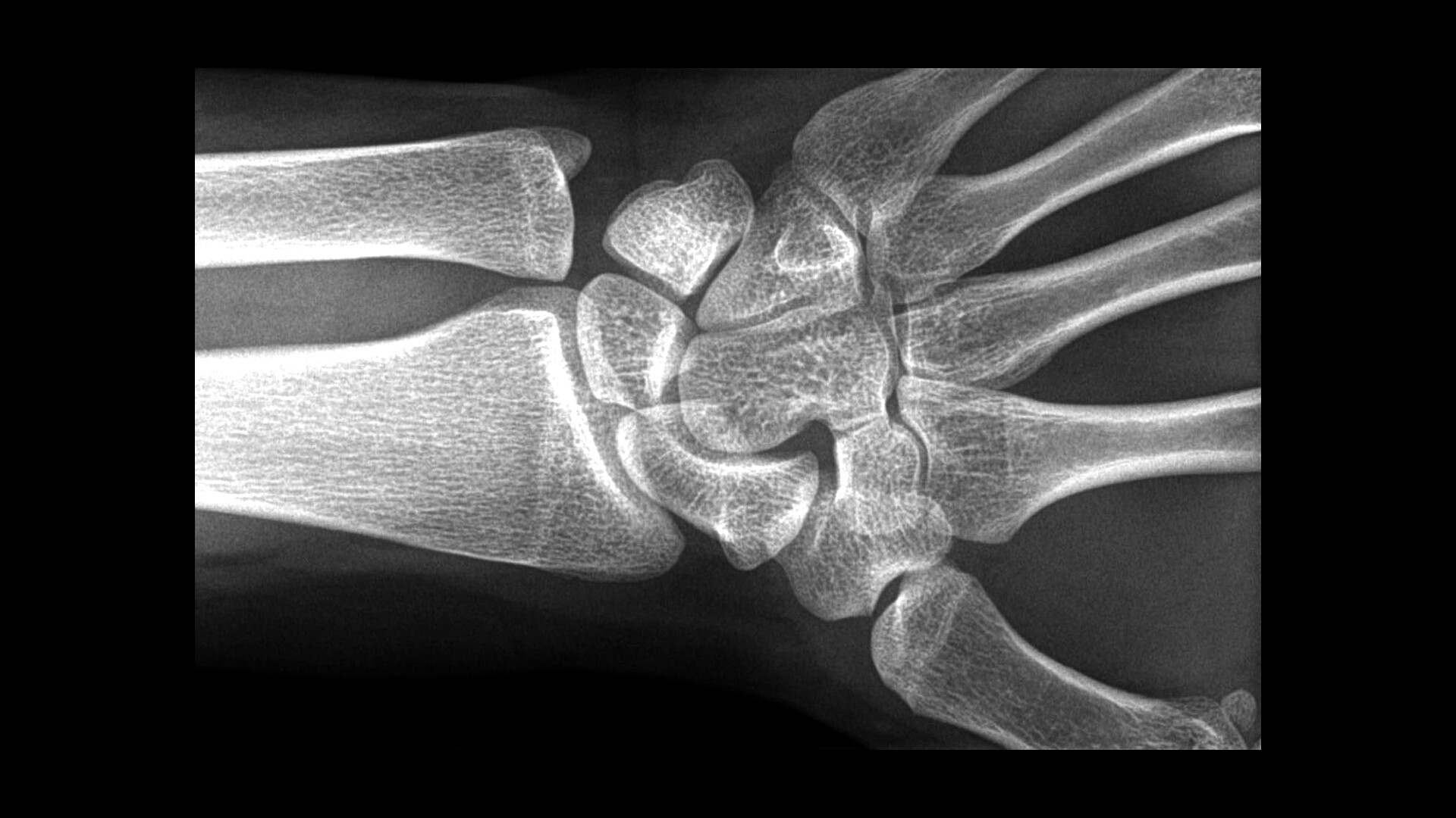 Tarsal-Carpal Coalition Syndrome - StoryMD