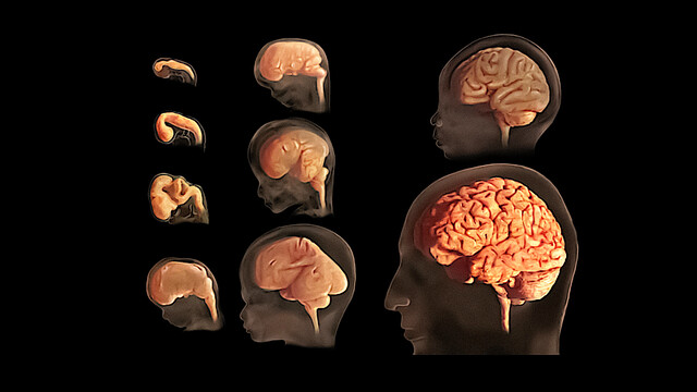 Glutamate Formiminotransferase Deficiency