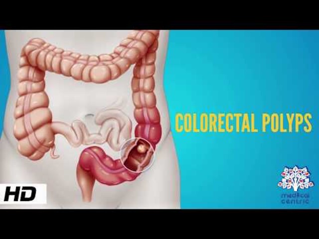 What Are the Symptoms of Colorectal Cancer?