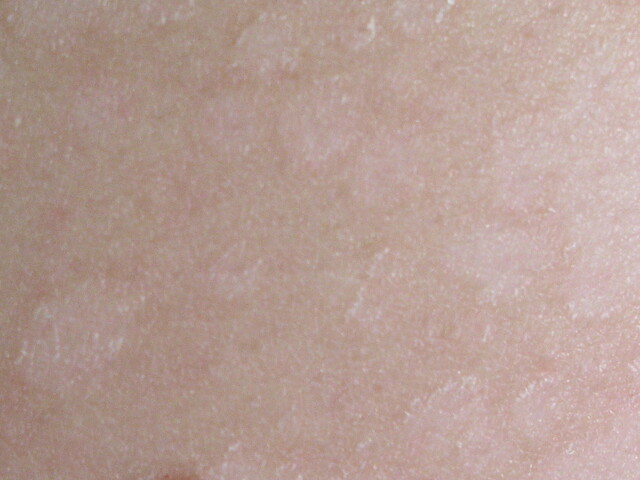 Tinea versicolor: Foothill Dermatology Medical Center: Dermatology
