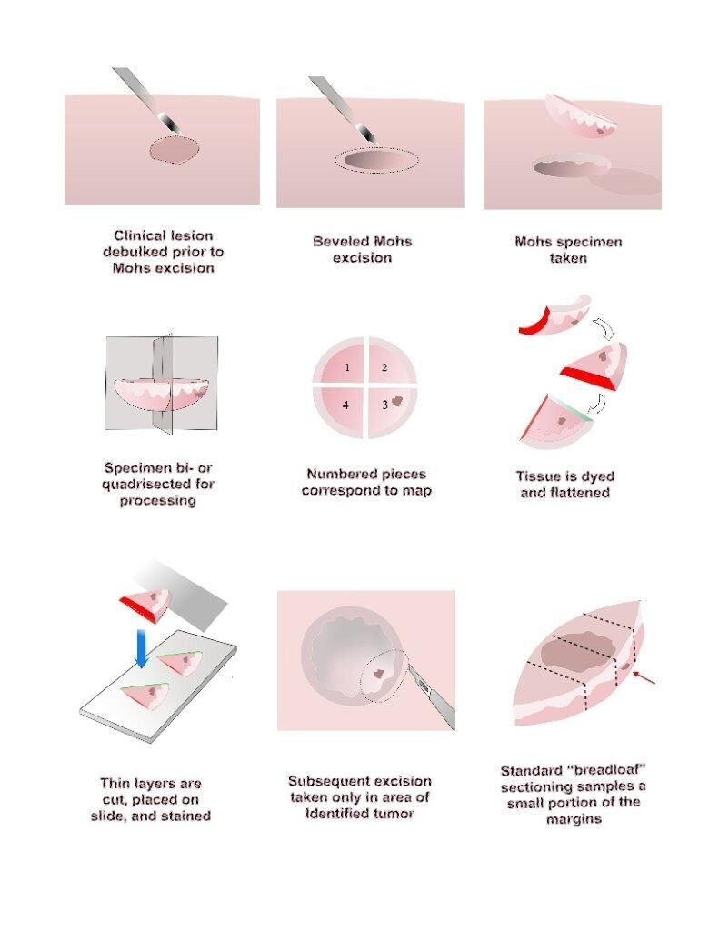 Mohs Micrographic Surgery Clinical Storymd