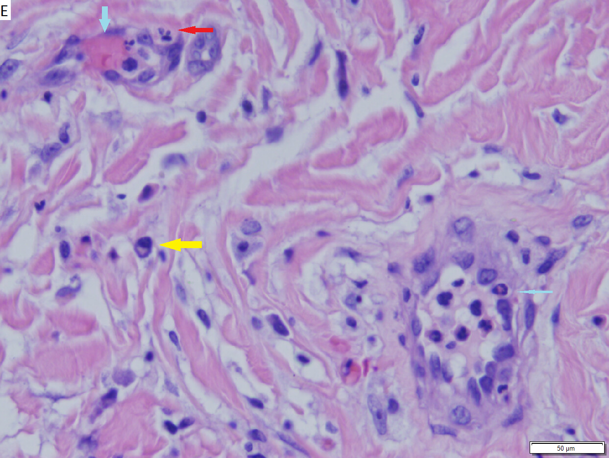 Erythema Elevatum Diutinum Images