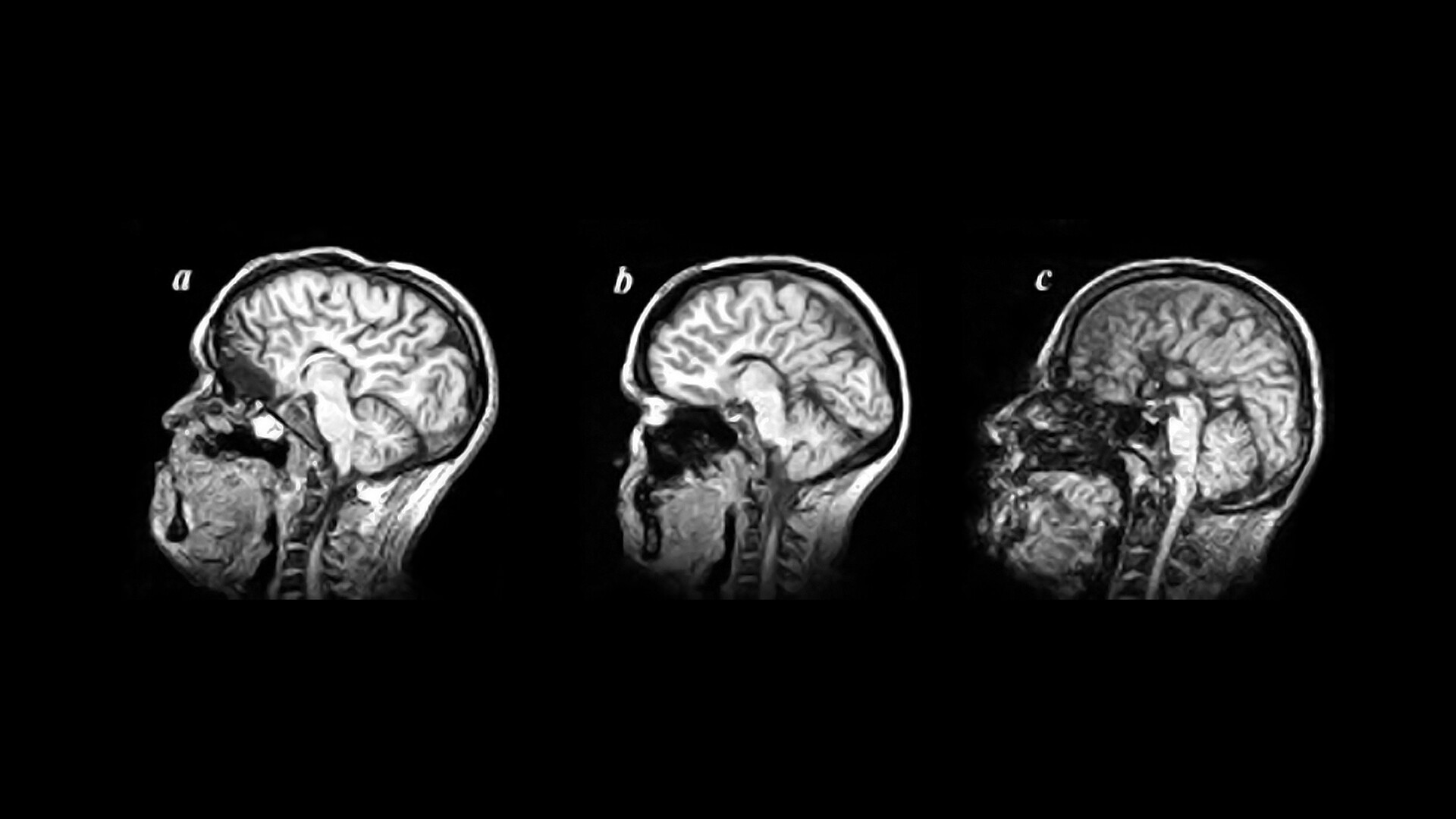 Гипоплазия червя. Дисгенезия мозолистого тела. Гипоплазия мозолистого тела головного мозга на УЗИ. ВПР ЦНС агенезия мозолистого тела.