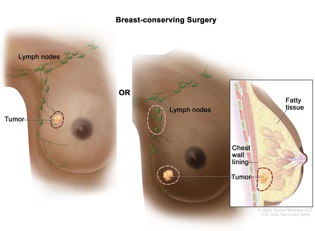 Triple-Negative Breast Cancer - StoryMD
