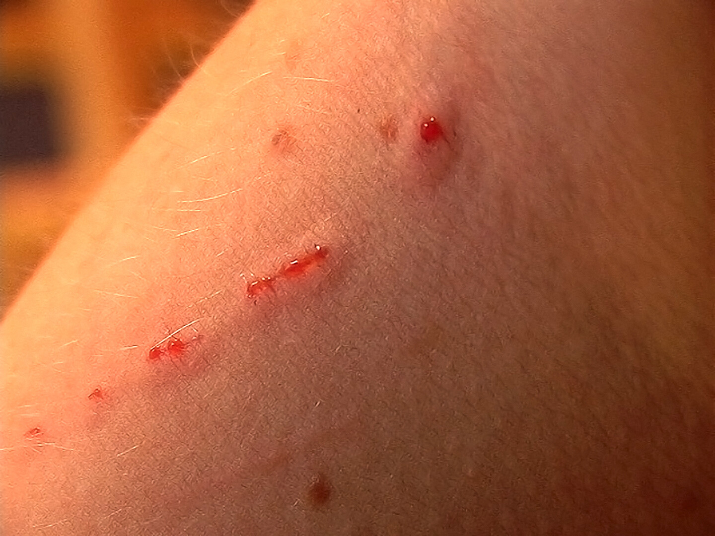 What Are The Signs And Symptoms Of Cat Scratch Disease StoryMD