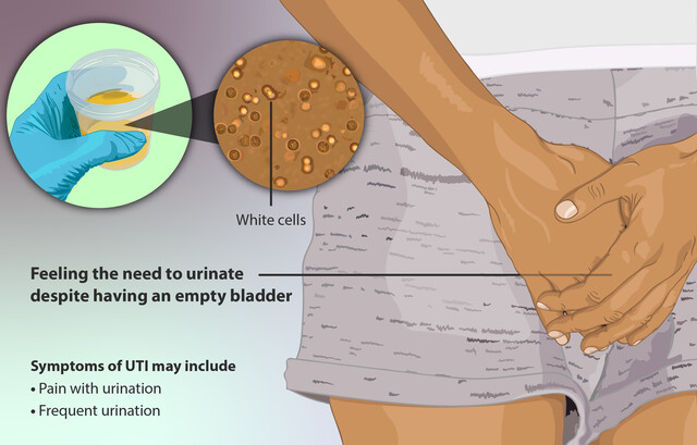 Cigarettes After Sex? Try Peeing Instead to Prevent a UTI