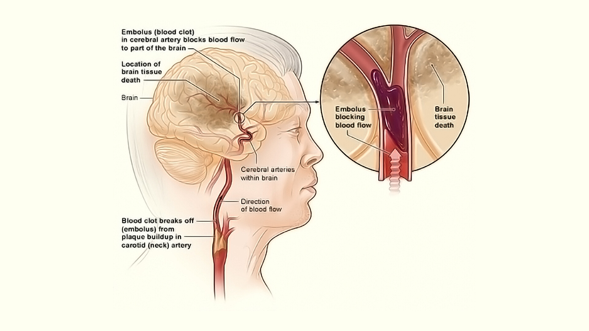 Ischemic stroke. Тромбоз мозговых сосудов. Тромбоз церебральных артерий.