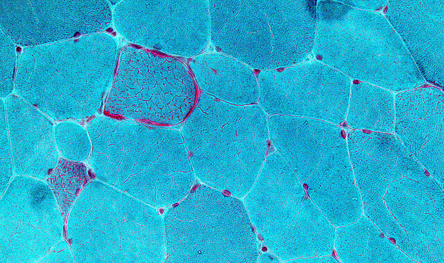 Myoclonic Epilepsy with Ragged-Red Fibers (MERRF): Causes, Treatment