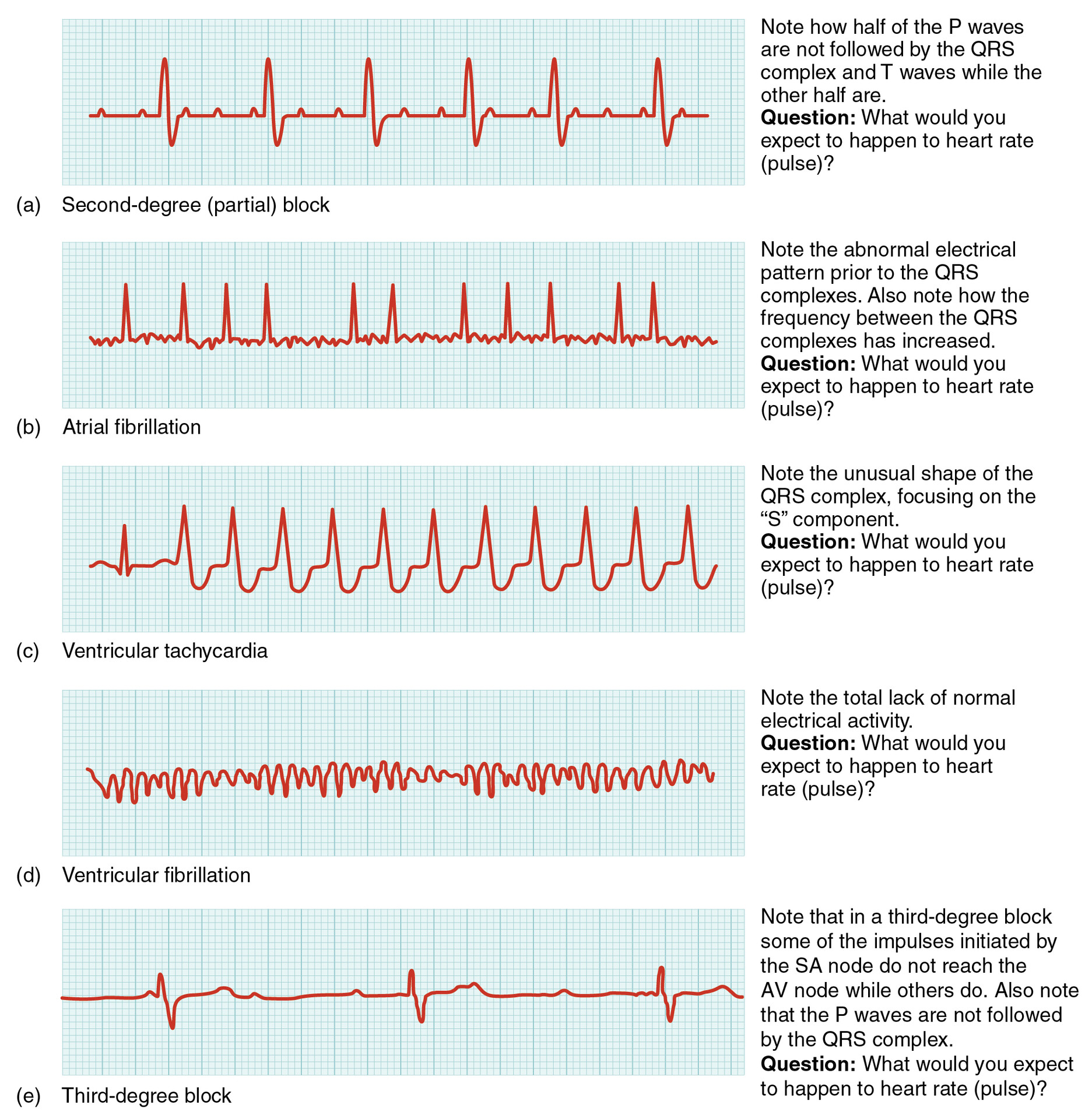 How To Read Abnormal Ecg Report - Printable Templates Protal