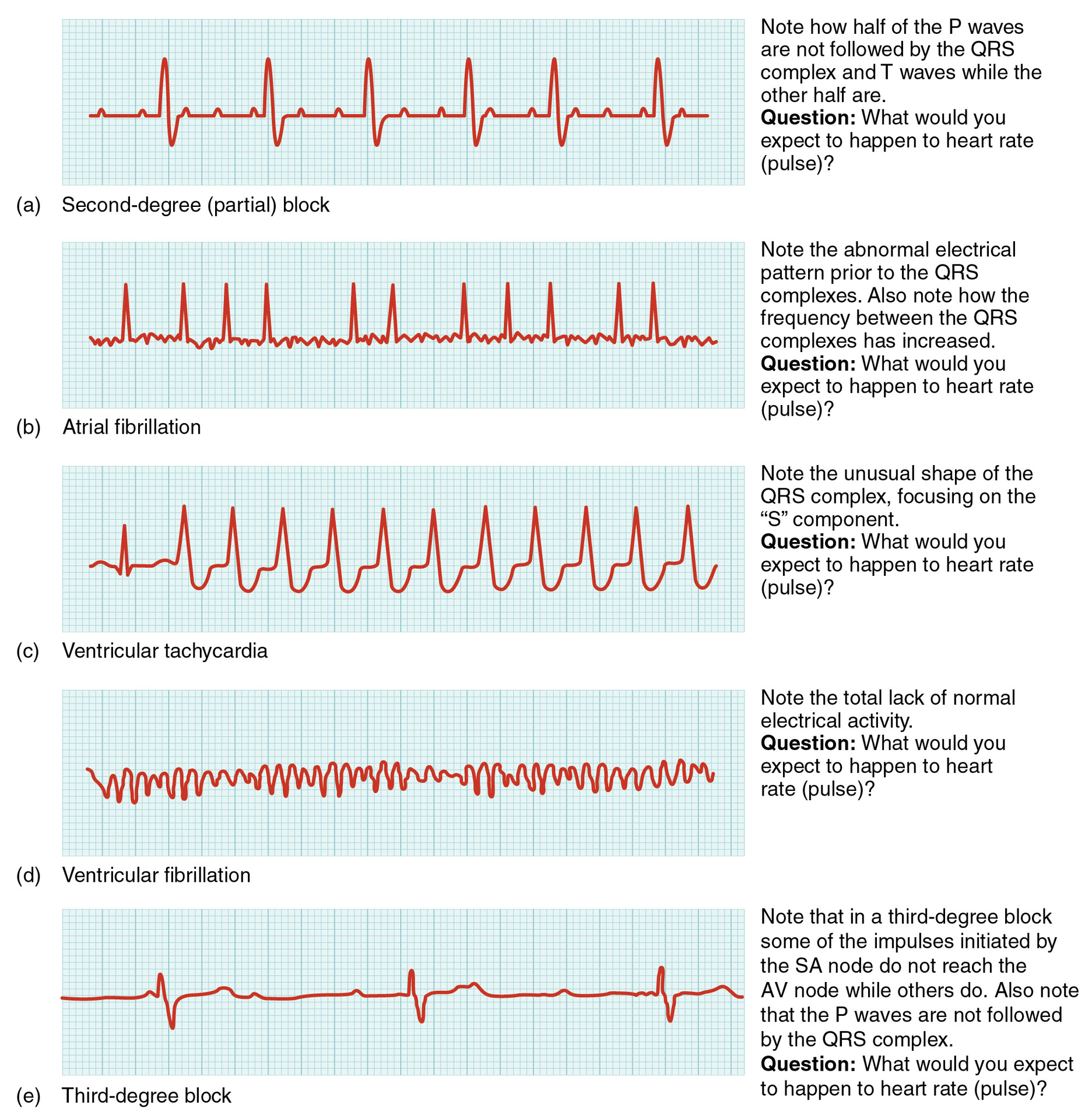 ecg-abnormalities-storymd