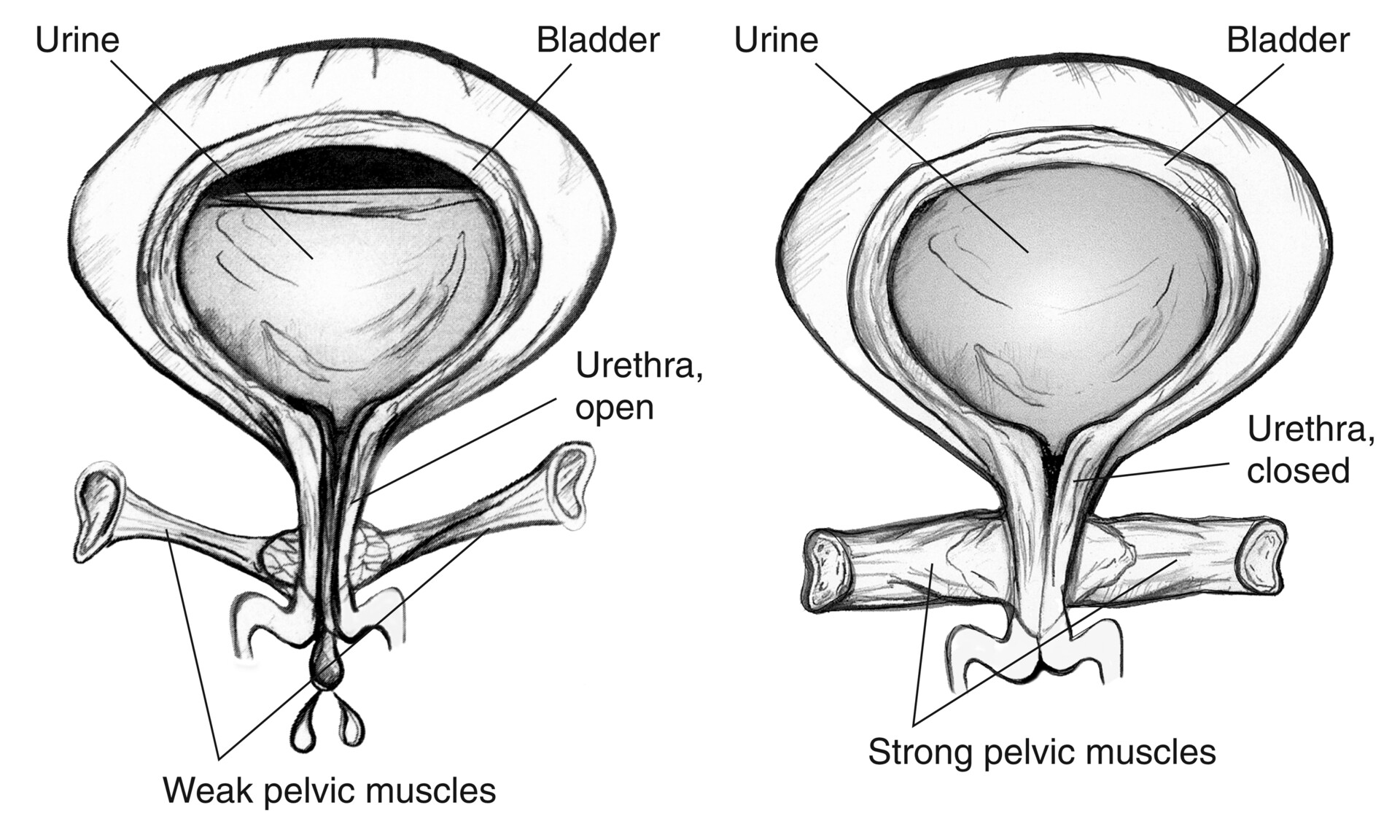 About Pelvic Floor Disorders (PFDs) - Maiden Lane Medical