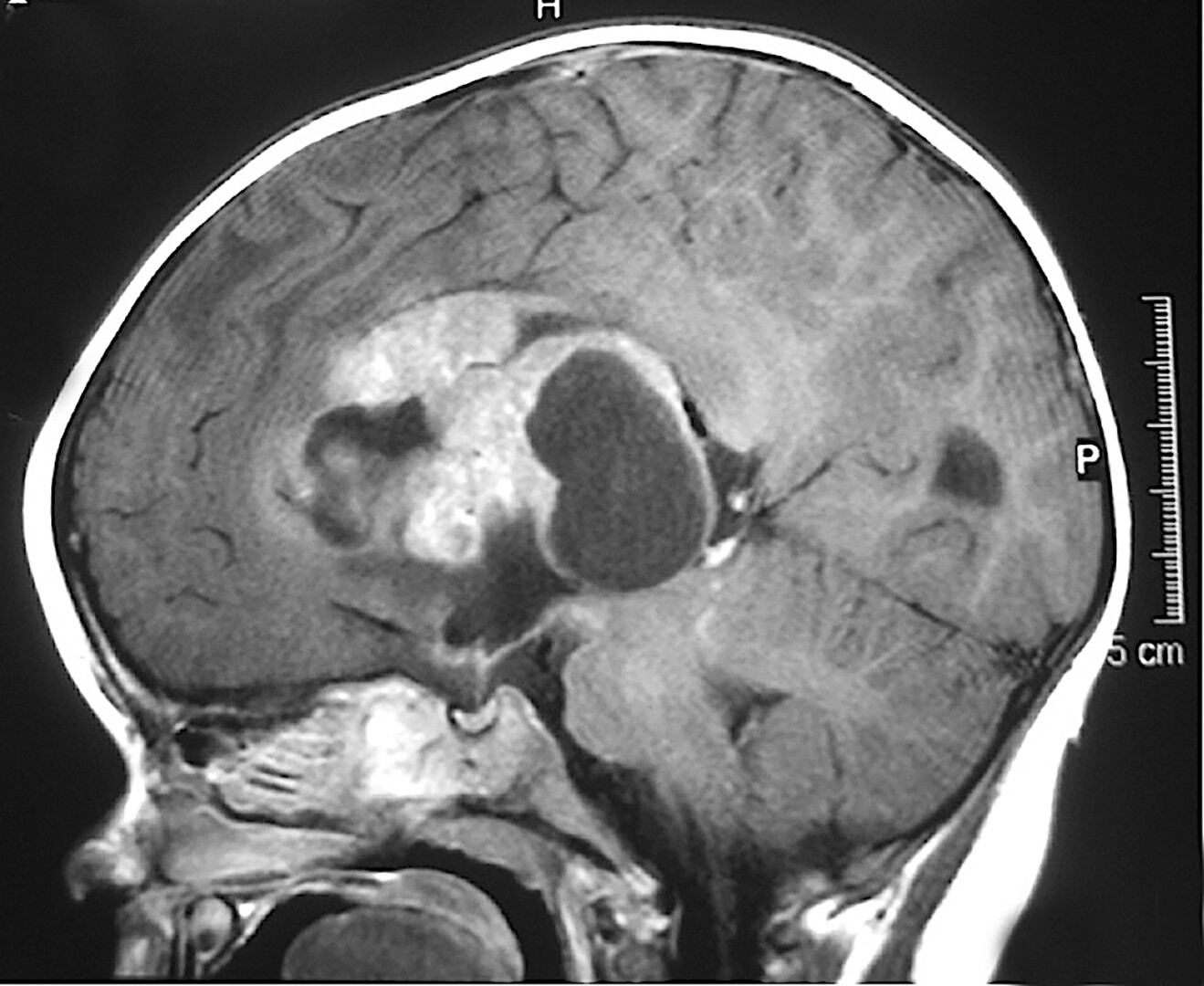 Опухоль головного мозга отек. Атипичная тератоид-рабдоидная опухоль. Опухоль головного мозга глиобластома.