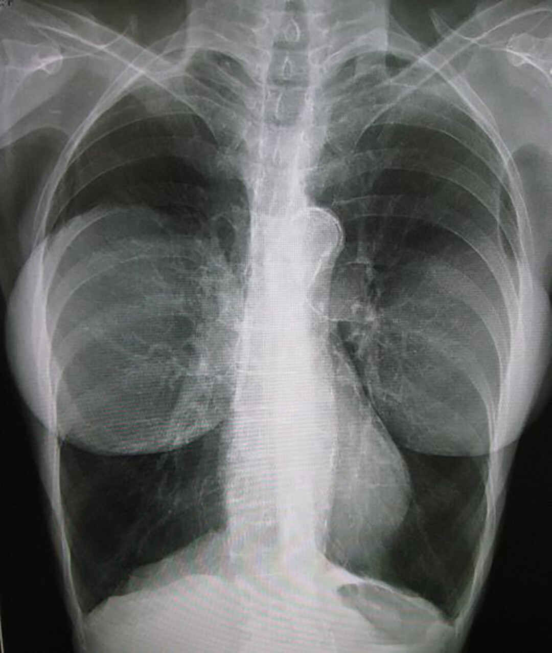 Thoracentesis - StoryMD