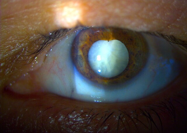 cerulean cataract
