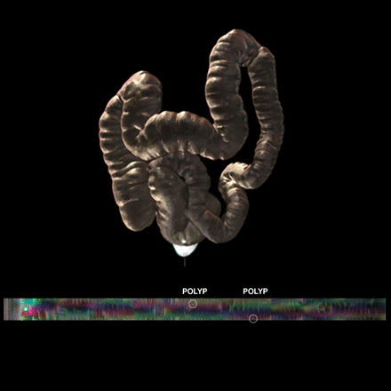 Virtual Colonoscopy: A Less Invasive Look