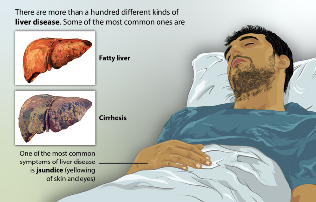 How Many People Have Liver Disease?