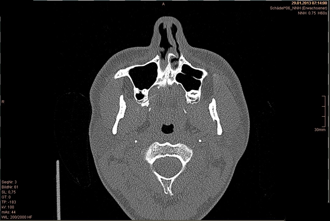 What Is Septoplasty? StoryMD