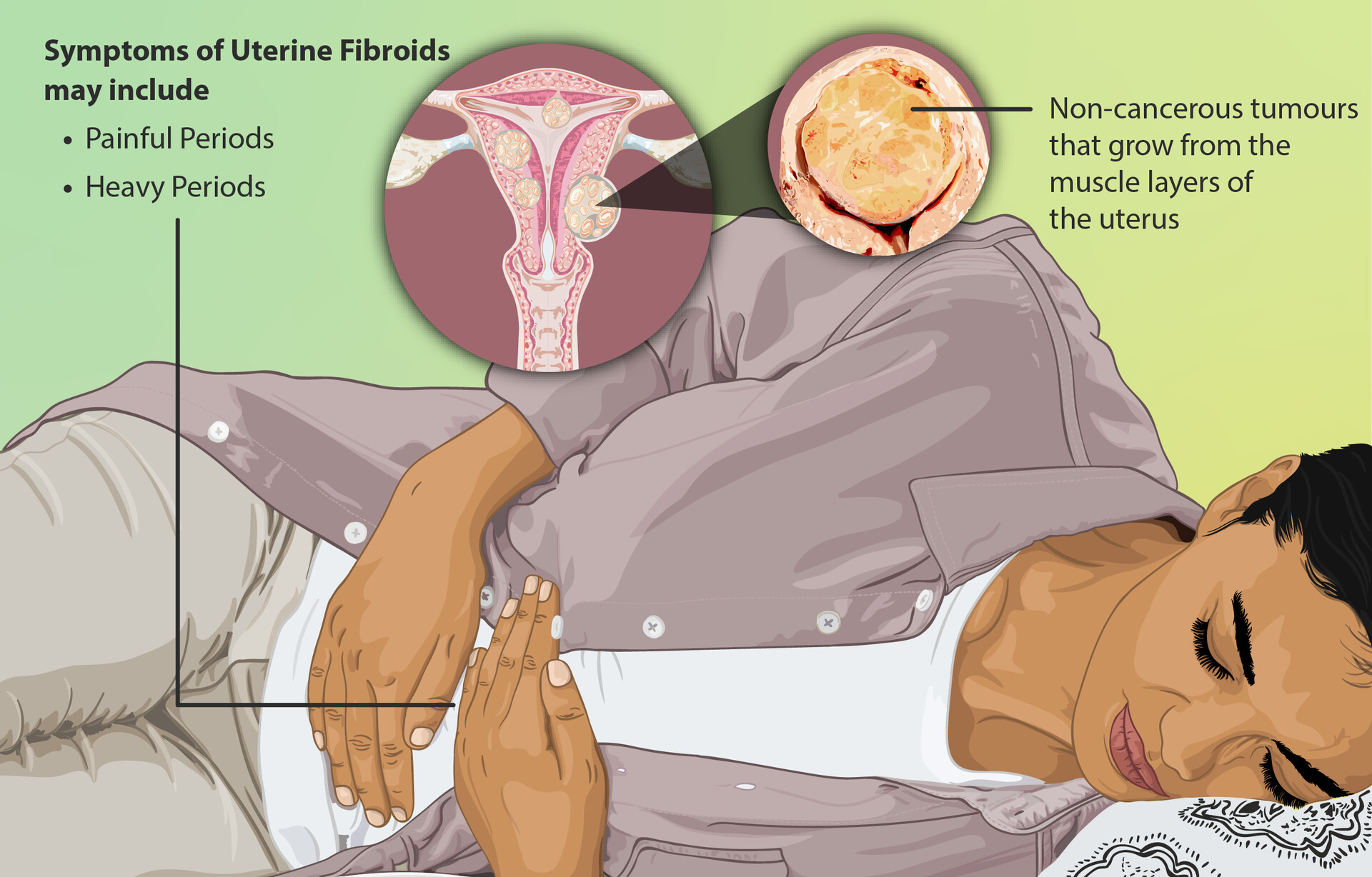 Learn Why Fibroids Cause Heavy Bleeding During & Between Periods!