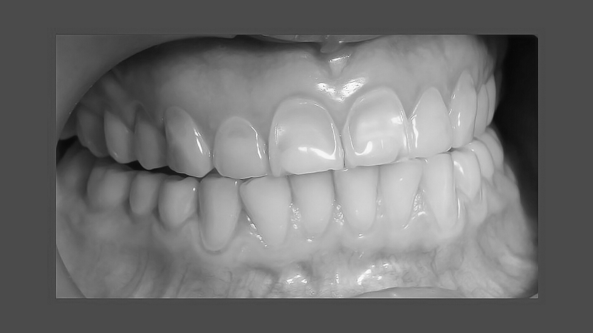 Dental Erosion - StoryMD