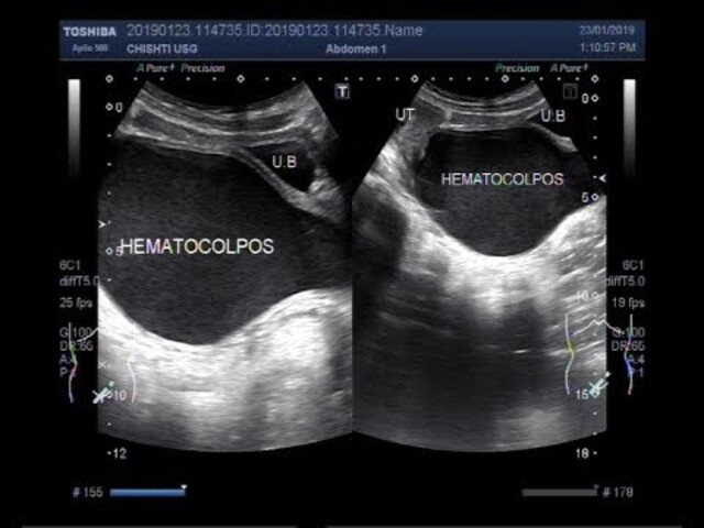 Ultrasound in Pregnancy - StoryMD