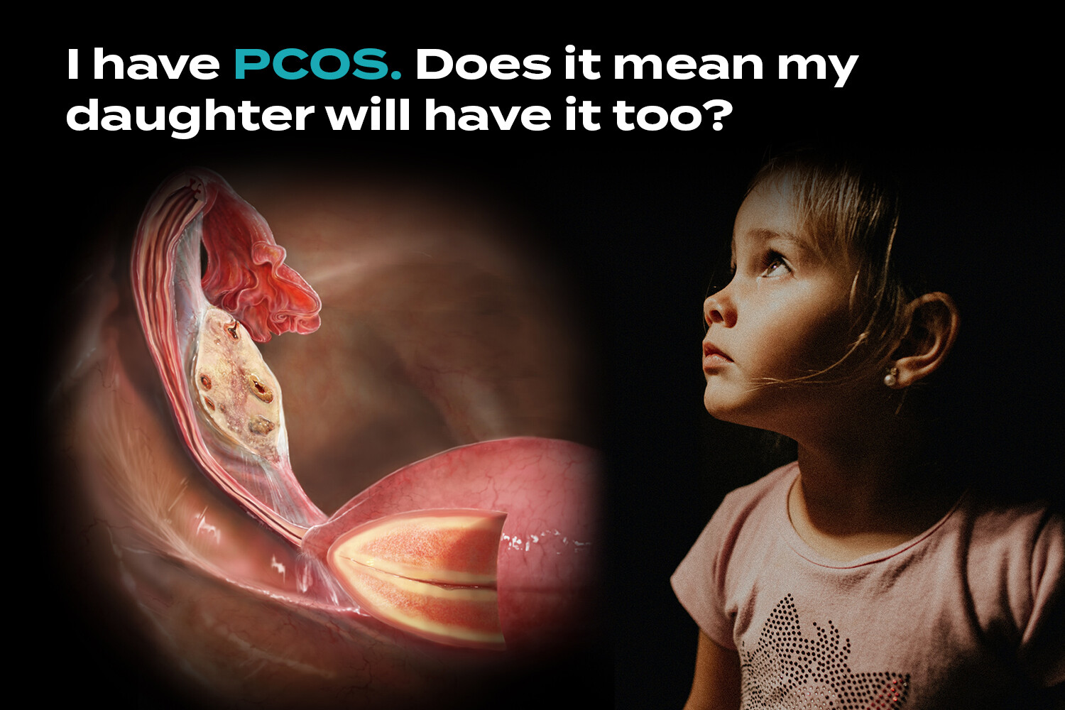 is-polycystic-ovary-syndrome-pcos-genetic-storymd