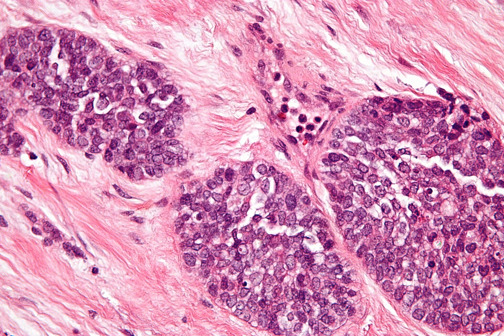 Desmoplastic Small Round Cell Tumor Survival Rate