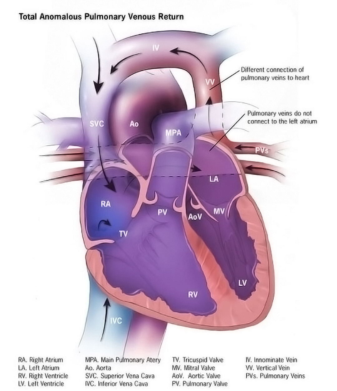 total-anomalous-pulmonary-venous-return-overview-storymd