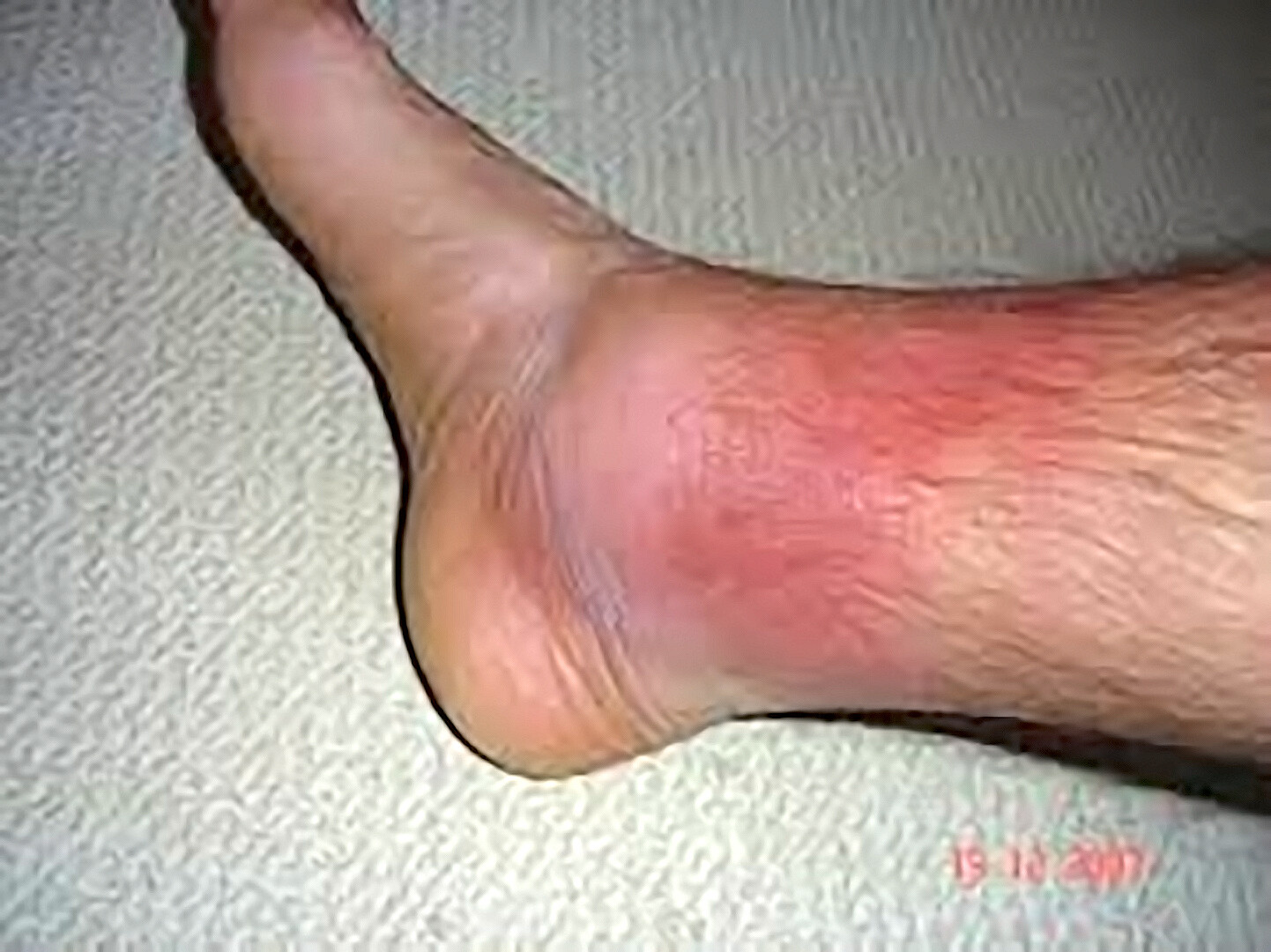 Traps Syndrome Rash Hugely Sale www.yakimankagbu.ru