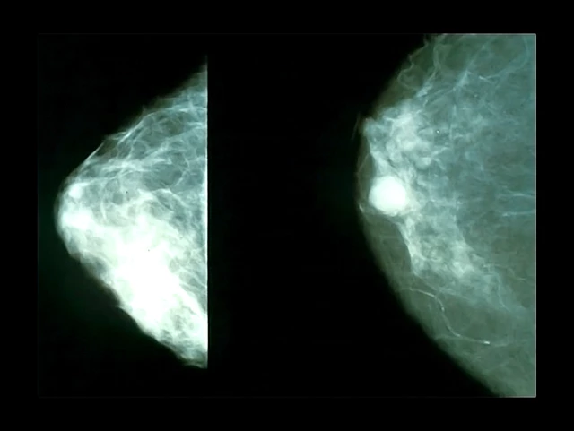 PHOTO GALLERY: What does breast cancer look like on mammography