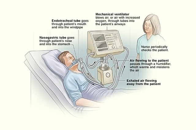 elfbar nachfüll pod läuft aus Removal of chlorhexidine for Ventilator-Associated Pneumonia preventio |  JMDH