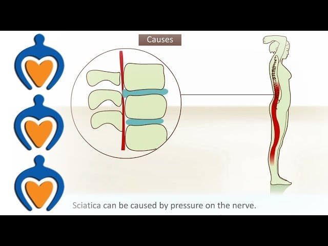 Sciatica - StoryMD