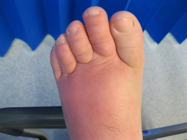 cellulitis foot