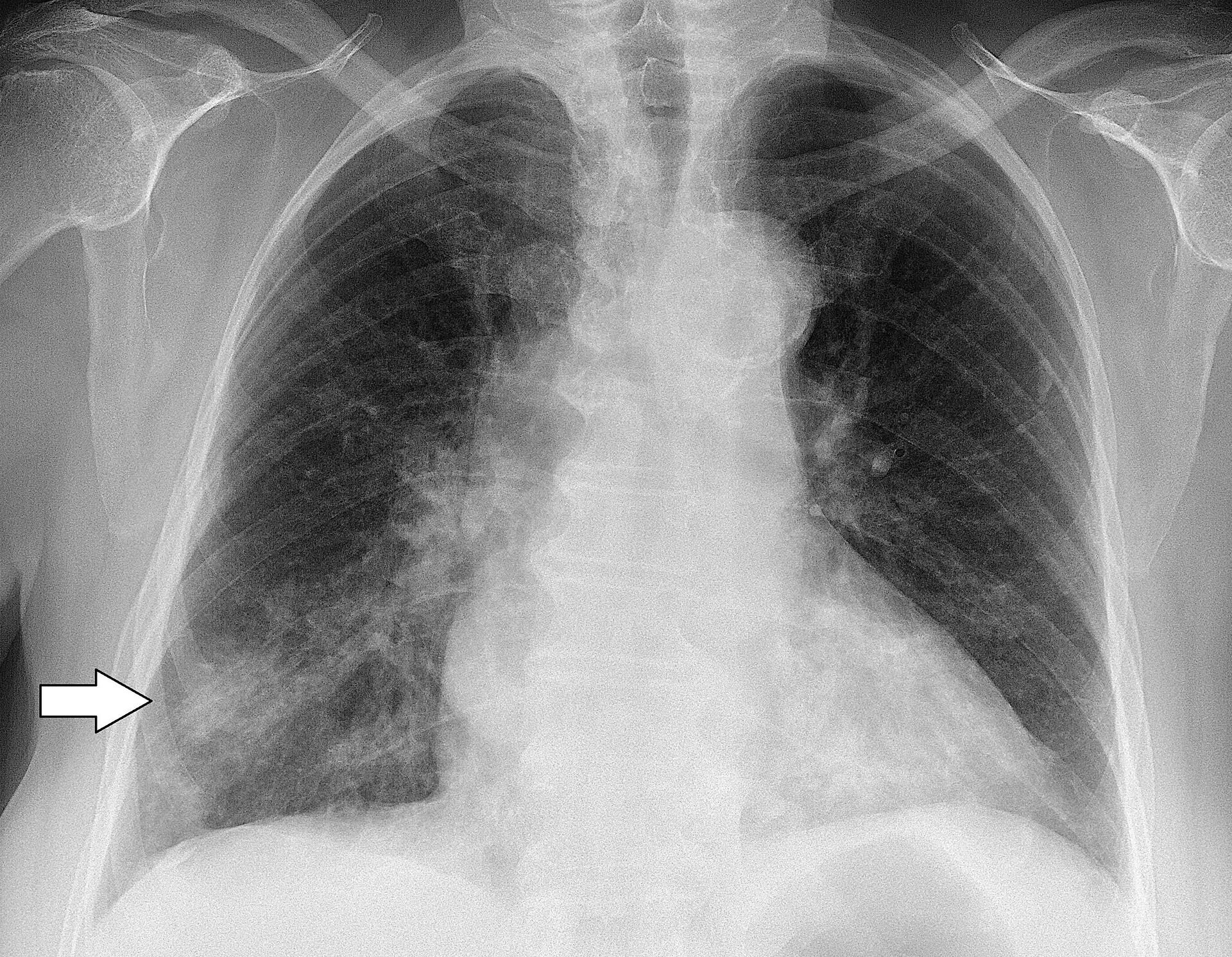 Haemophilus Influenzae StoryMD