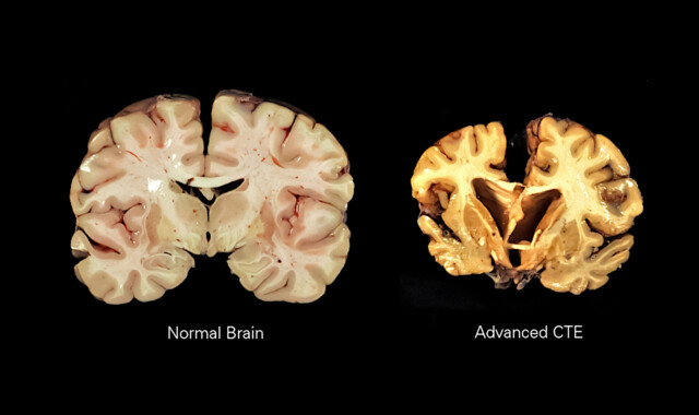 Chronic Traumatic Encephalopathy (CTE): Causes, Symptoms, Diagnosis ...