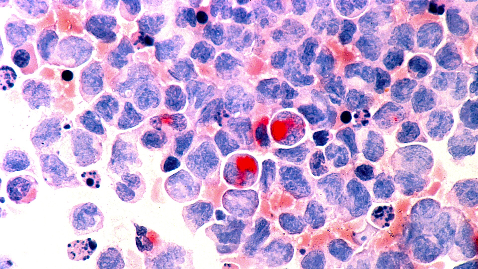 Childhood Acute Myeloid Leukemia - StoryMD