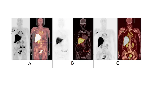 Related HealthJournals - Hormone Therapy for Breast Cancer - StoryMD