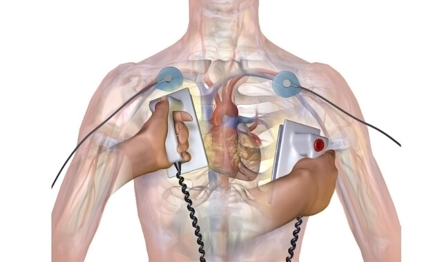 Cardioversion (Defibrillation): What to Expect - StoryMD