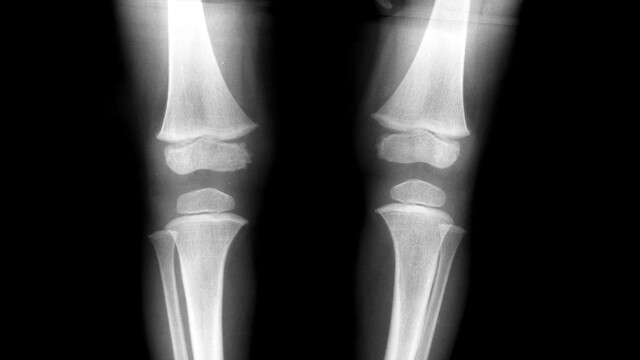 Rickets Disease Is Caused Due To Deficiency Of