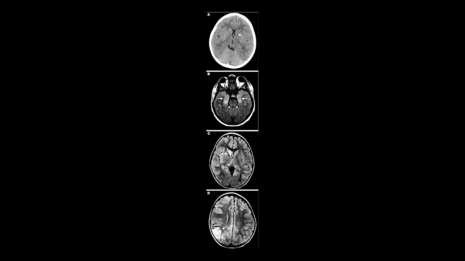 what-is-encephalitis-storymd