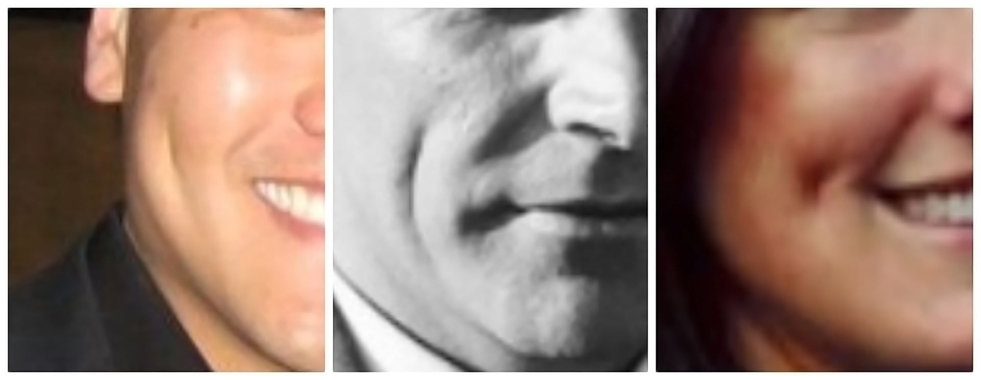 Are Dimples A Sign Of Deformity