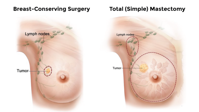 The ABCs of Breast Cancer: Understanding the Different Types - StoryMD