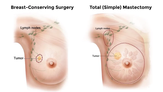 Types of Breast Lumps  K W Ong Breast & General Surgery :: K W