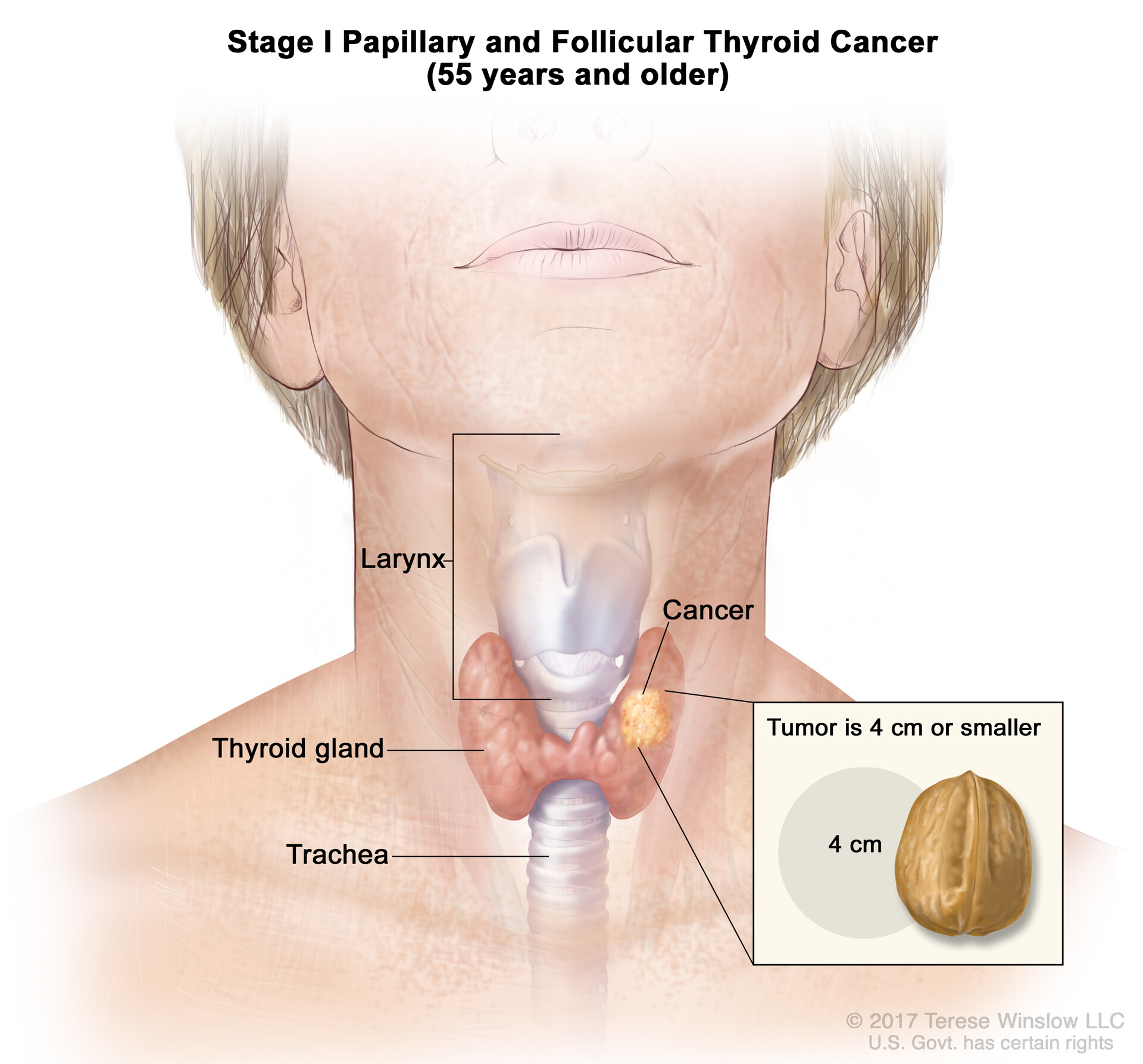 Papillary and Follicular Thyroid Cancer–Health Professional Version