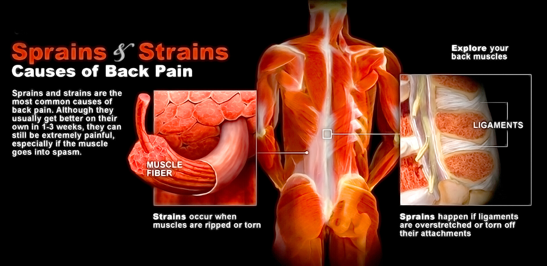 Strained Back Muscle – Causes, Symptoms and Treatment