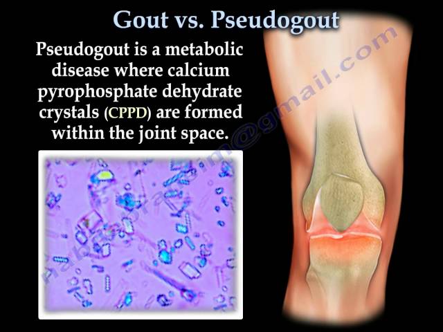 What Is Gout? - StoryMD
