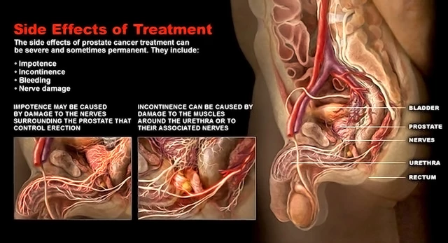 Best Prostate Cancer Hospital In India